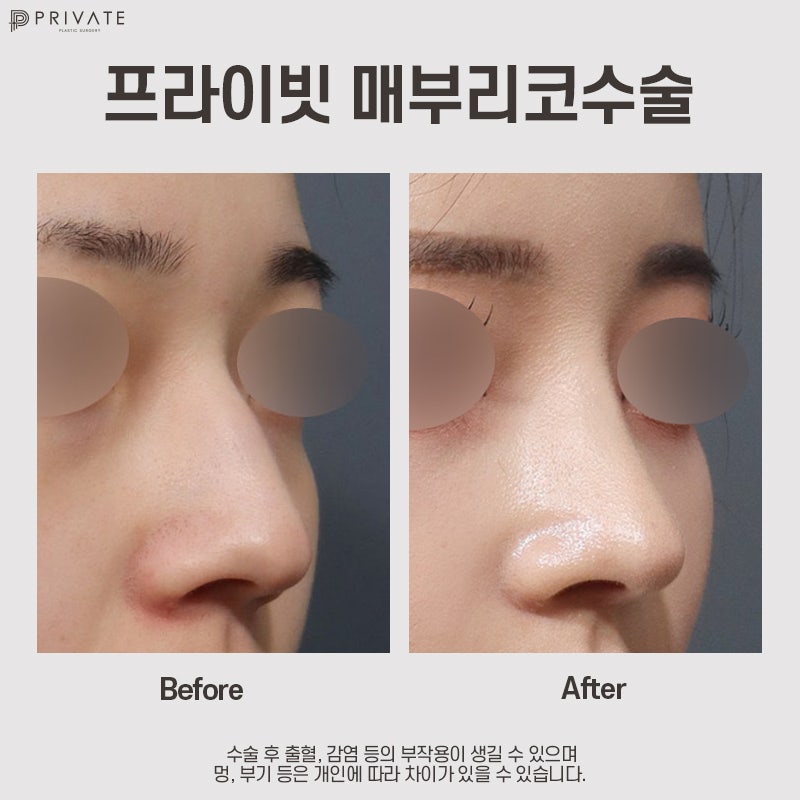 매부리코성형후기가 좋은 신사 프라이빗성형외과 사진 9