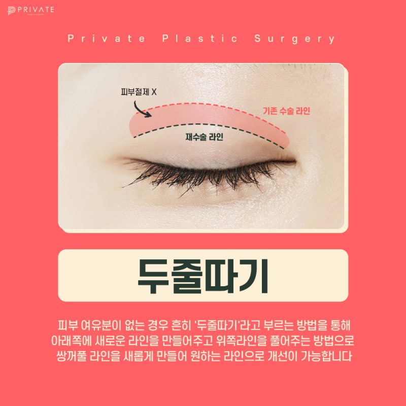 Operasi Rekonstruksi Mata di Sinsa Private Plastic Surgery, Tempat Terkenal 사진 5