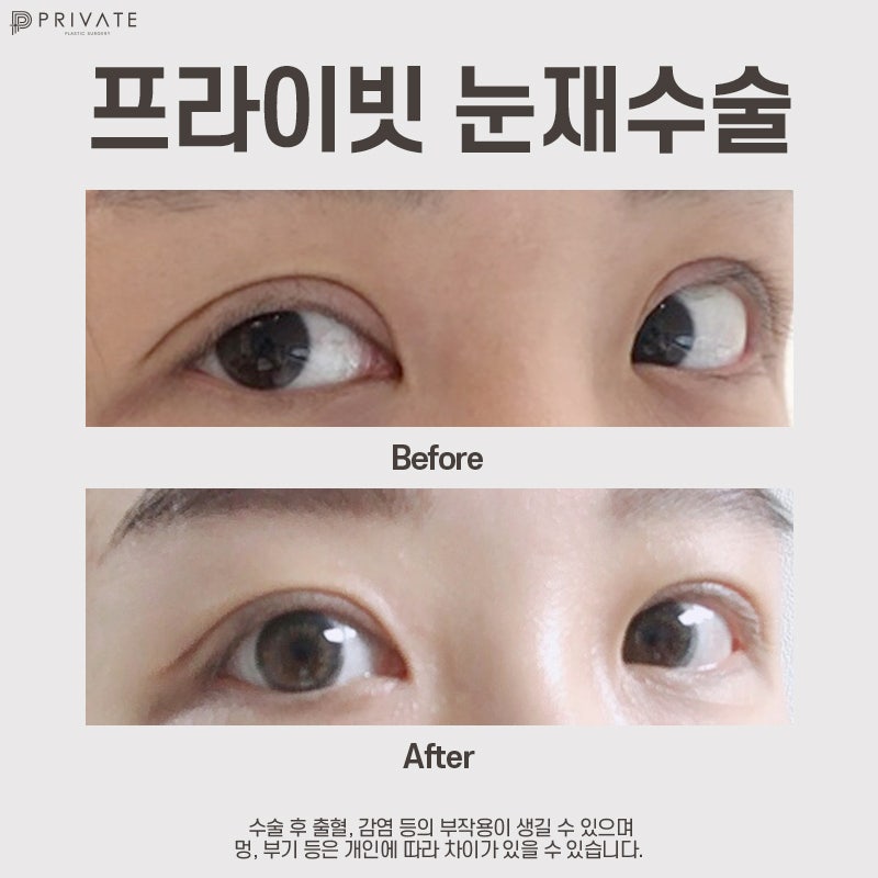 Operasi Rekonstruksi Mata di Sinsa Private Plastic Surgery, Tempat Terkenal 사진 8
