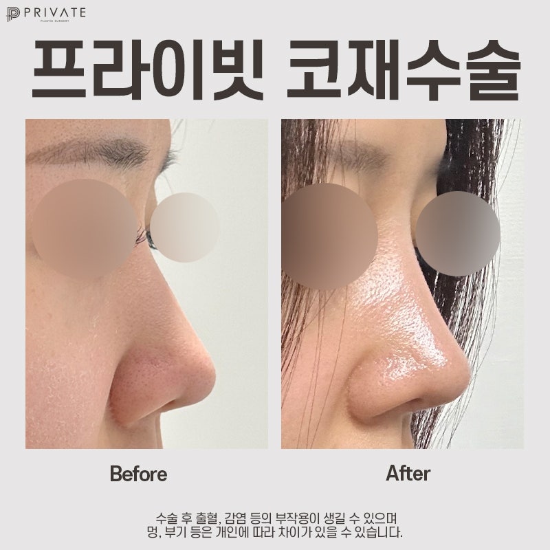 코재수술병원은 신사 프라이빗성형외과 사진 10