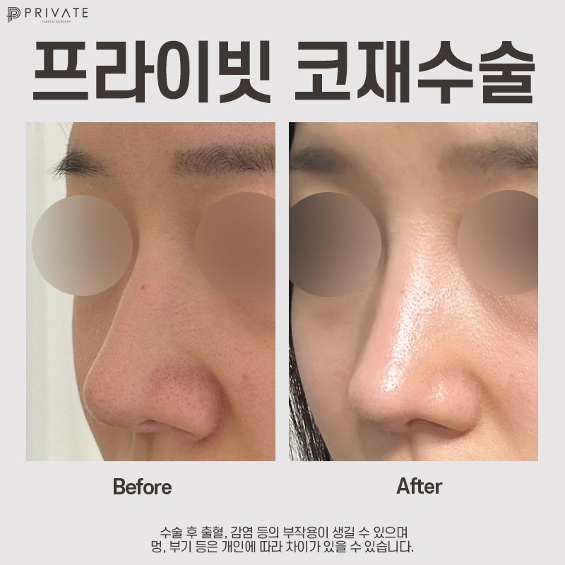 코재수술병원은 신사 프라이빗성형외과 사진 9