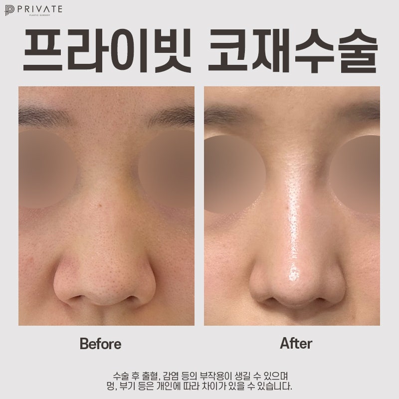 코재수술병원은 신사 프라이빗성형외과 사진 8