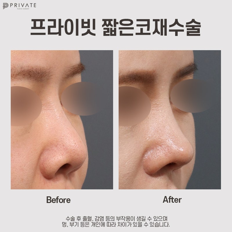 짧은코재수술잘하는곳은 프라이빗성형외과 사진 9