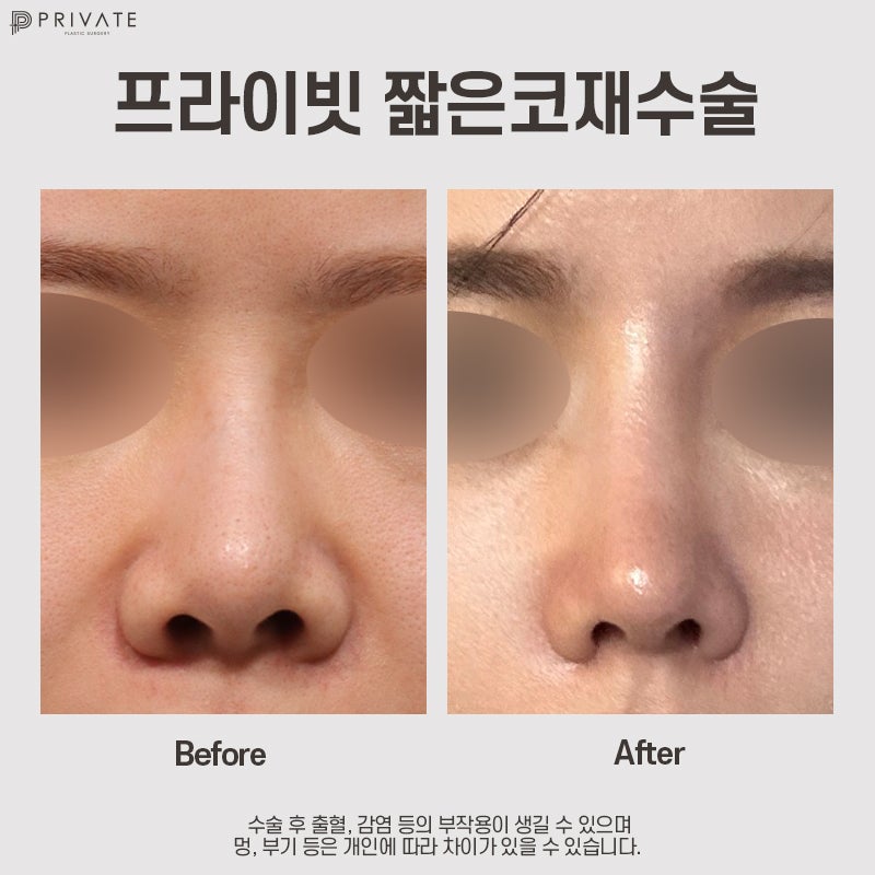 짧은코재수술잘하는곳은 프라이빗성형외과 사진 8