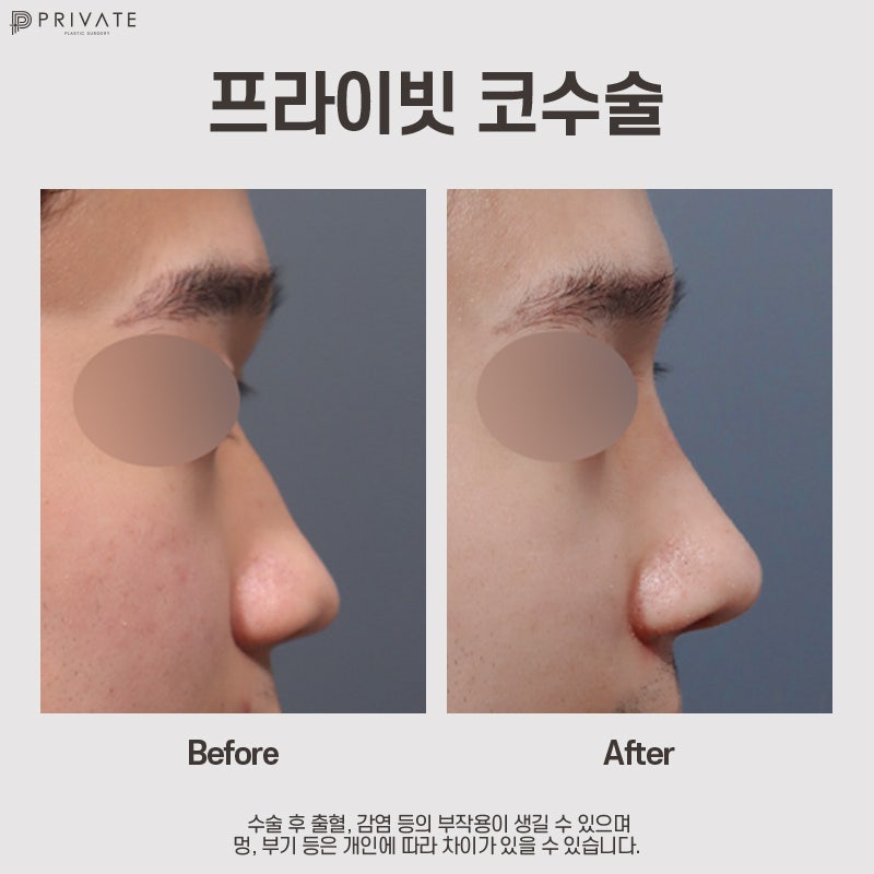 عيادة جراحة التجميل الخاصة التي تحظى بمراجعات جيدة قبل وبعد تجميل الأنف للرجال 사진 10