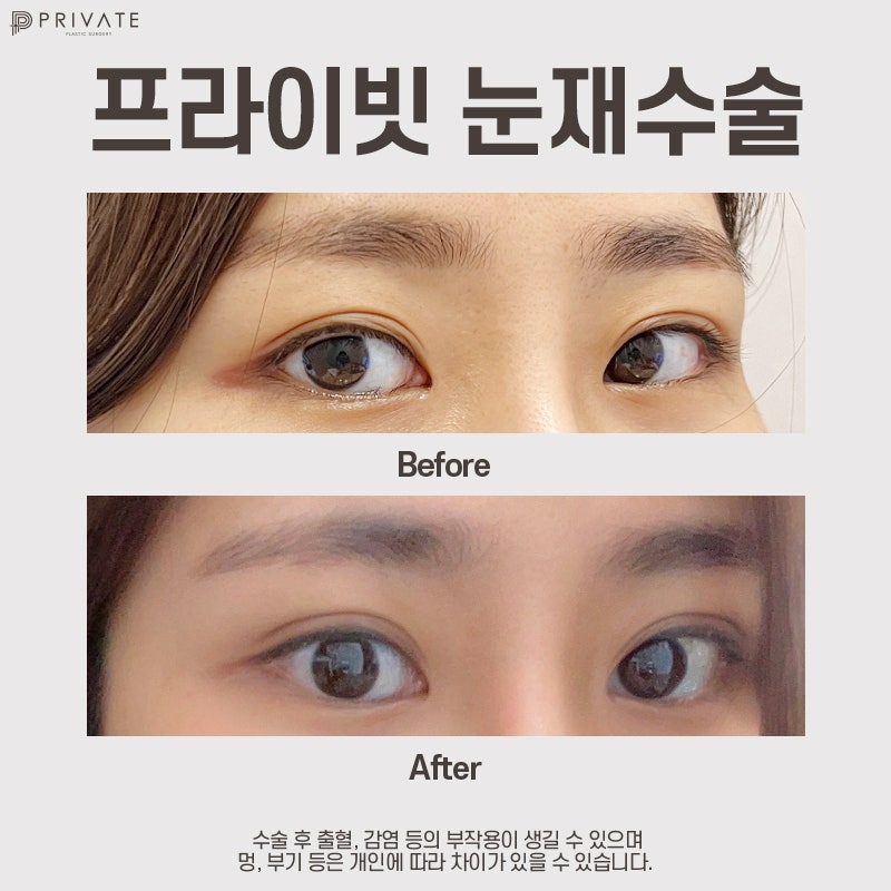 쌍수재수술후기 좋은 신사 프라이빗성형외과 사진 9