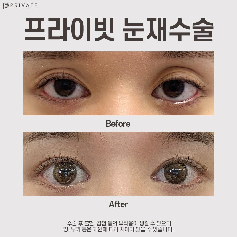 쌍수재수술후기 좋은 신사 프라이빗성형외과 사진 8