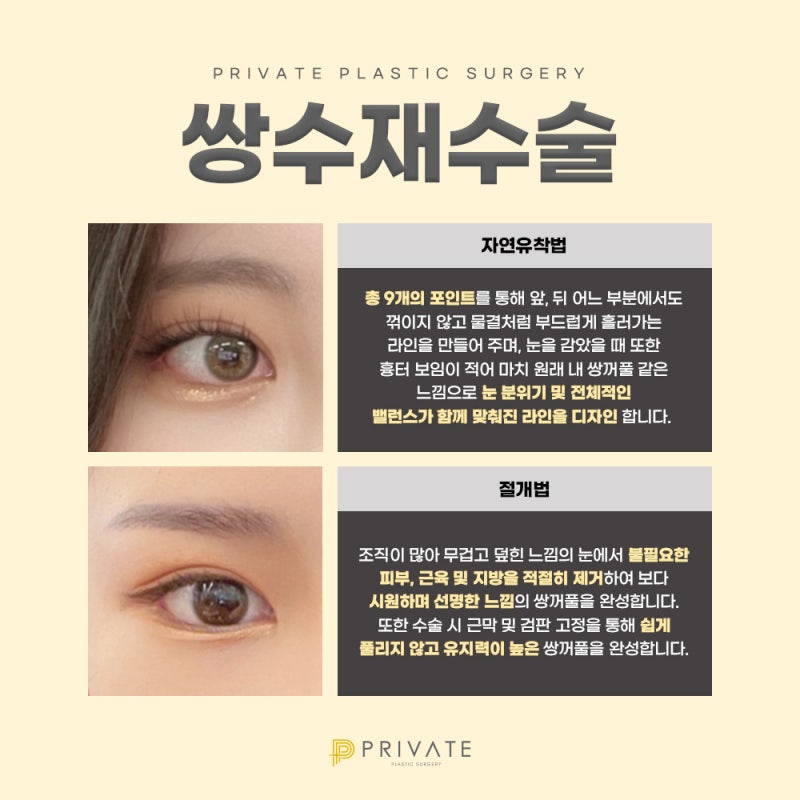 쌍수재수술후기 좋은 신사 프라이빗성형외과 사진 4