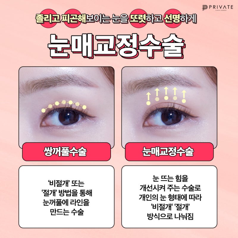 Tempat Terbaik untuk Koreksi Ptosis Mata: Private Plastic Surgery 사진 4