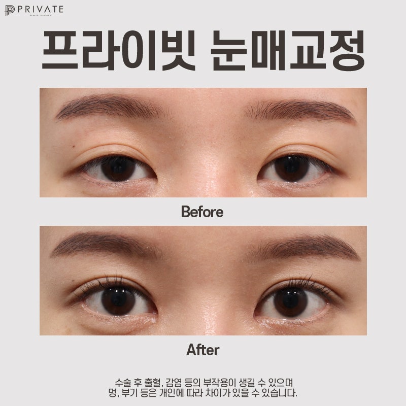 Tempat Terbaik untuk Koreksi Ptosis Mata: Private Plastic Surgery 사진 7