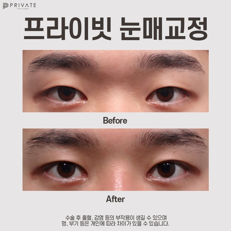 Tempat Terbaik untuk Koreksi Ptosis Mata: Private Plastic Surgery 사진 8