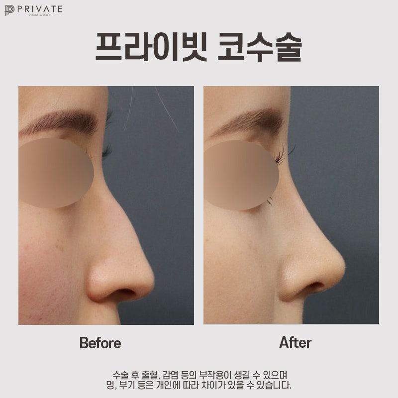 Operasi Koreksi Hidung Panah, Cari Tahu di Private Plastic Surgery 사진 9