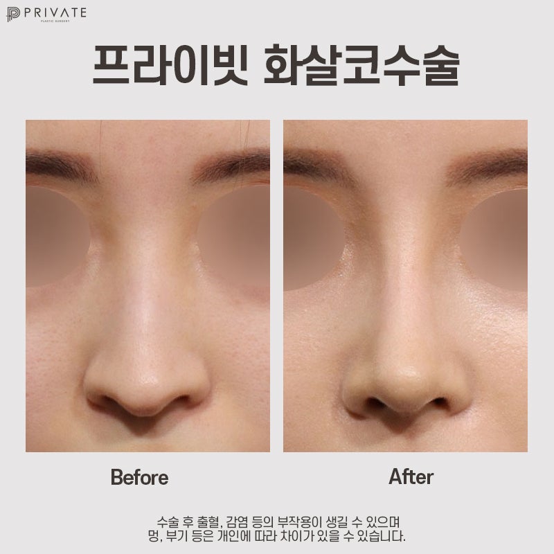 Operasi Koreksi Hidung Panah, Cari Tahu di Private Plastic Surgery 사진 7