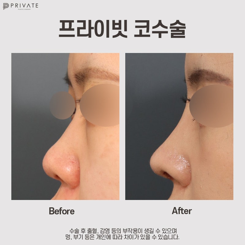 Klinik Bedah Plastik Swasta dengan Ulasan Rhinoplasty yang Baik 사진 8