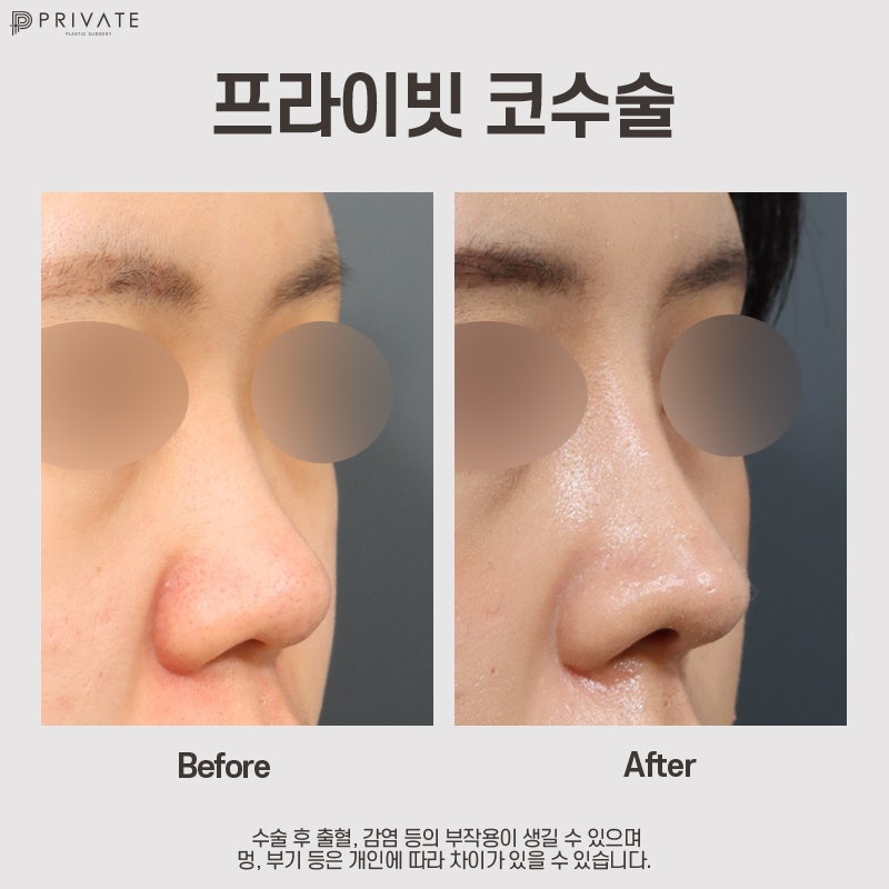 Klinik Bedah Plastik Swasta dengan Ulasan Rhinoplasty yang Baik 사진 9