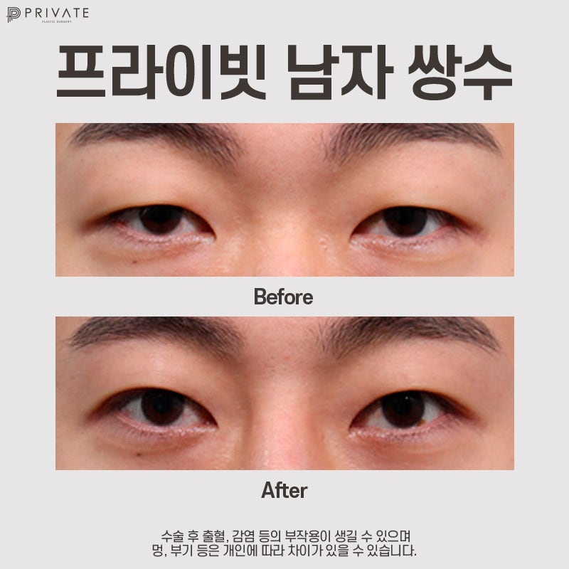 Private Plastic Surgery Clinic: The Best Place for Male Eye Surgery 사진 7