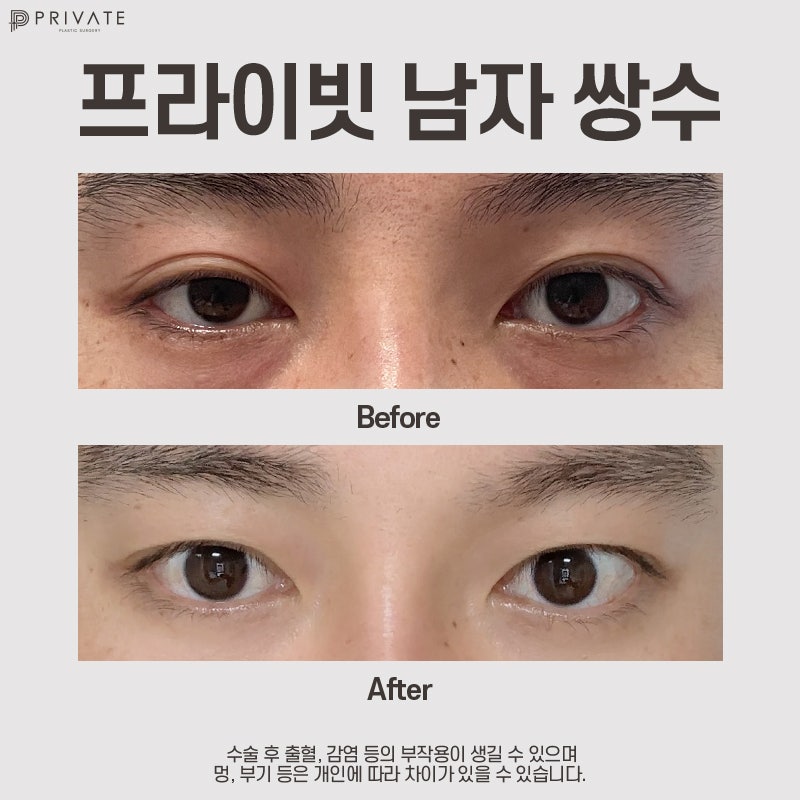 Private Plastic Surgery Clinic: The Best Place for Male Eye Surgery 사진 8