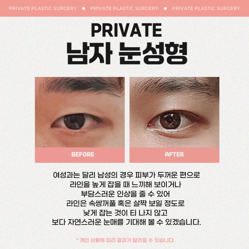 Private Plastic Surgery Clinic: The Best Place for Male Eye Surgery