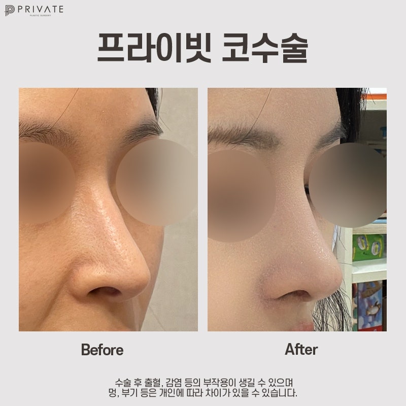 자가늑코수술잘하는곳 프라이빗성형외과 사진 7