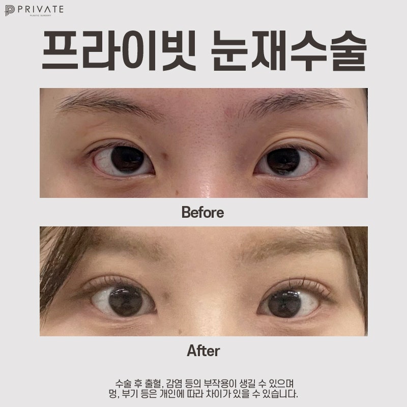 Bedah Revisi Mata Sayatan Terbaik di Sinsa Private Plastic Surgery 사진 8