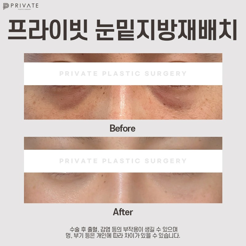 눈밑지잘하는병원은 신사 프라이빗성형외과 사진 8