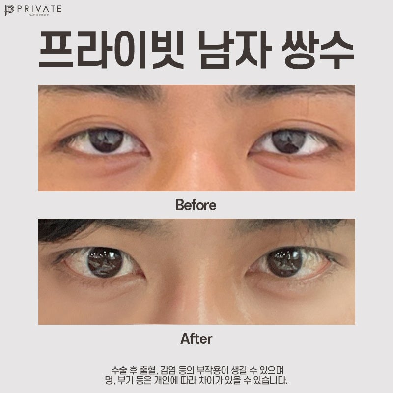 남자 눈수술 잘하는병원은 신사 프라이빗성형외과 사진 8