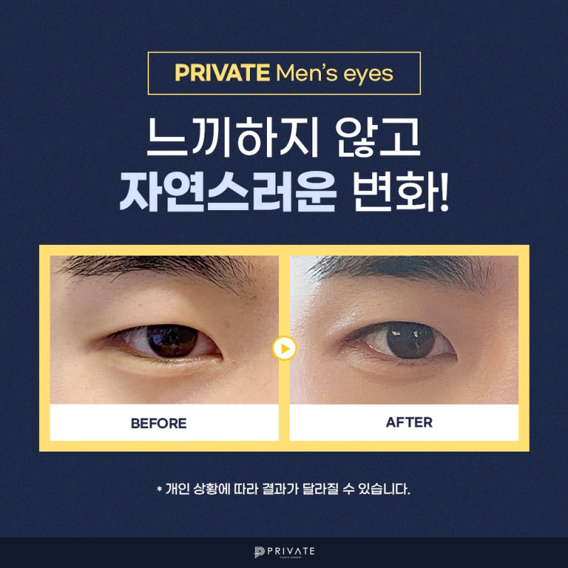남자 눈수술 잘하는병원은 신사 프라이빗성형외과 사진 5