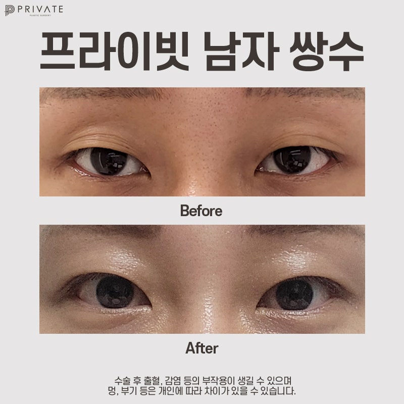 남자 눈수술 잘하는병원은 신사 프라이빗성형외과 사진 9