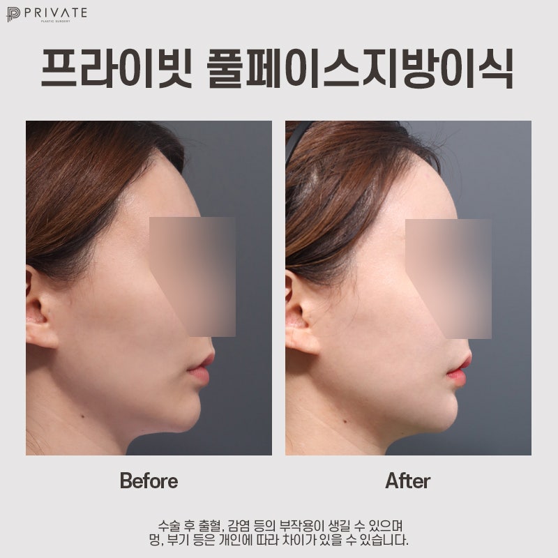 Transplantasi Lemak Wajah Penuh PRP di Private Plastic Surgery 사진 11