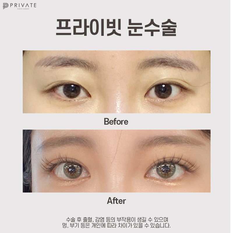 Operasi Plastik Mata Pertama di Private Plastic Surgery Sinsa Station 사진 9