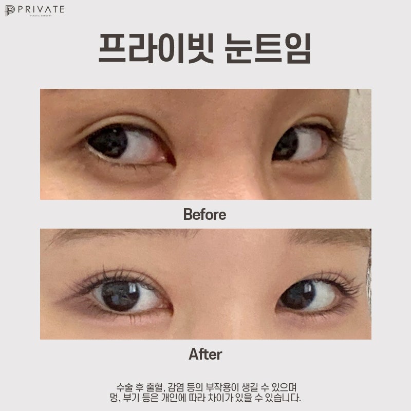 Ulasan Bagus Operasi Canthoplasty Lateral dan Epicanthoplasty Lateral di Private Plastic Surgery Sinsa-dong 사진 10