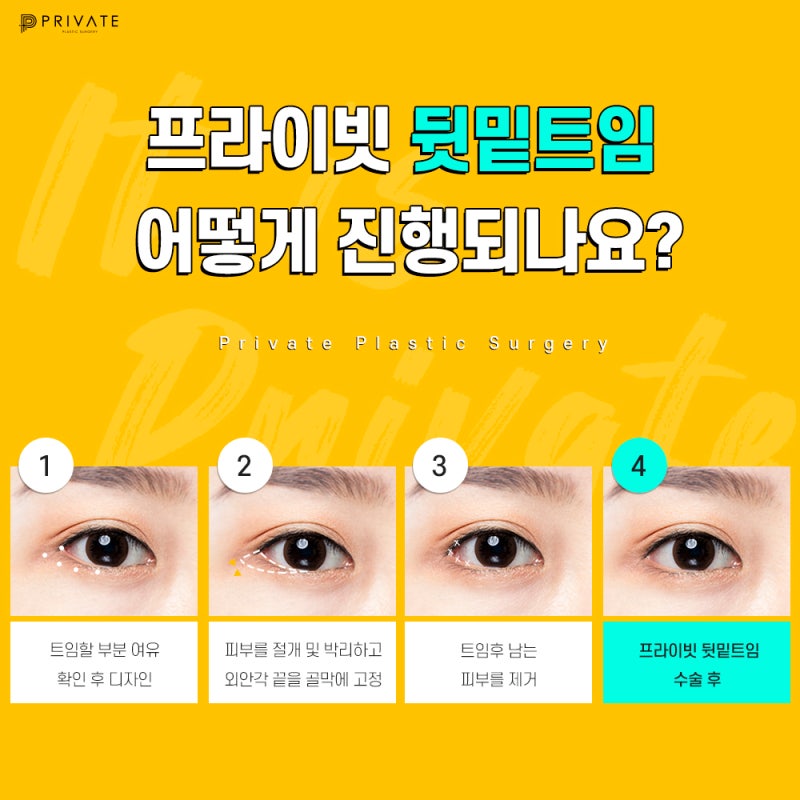 Ulasan Bagus Operasi Canthoplasty Lateral dan Epicanthoplasty Lateral di Private Plastic Surgery Sinsa-dong