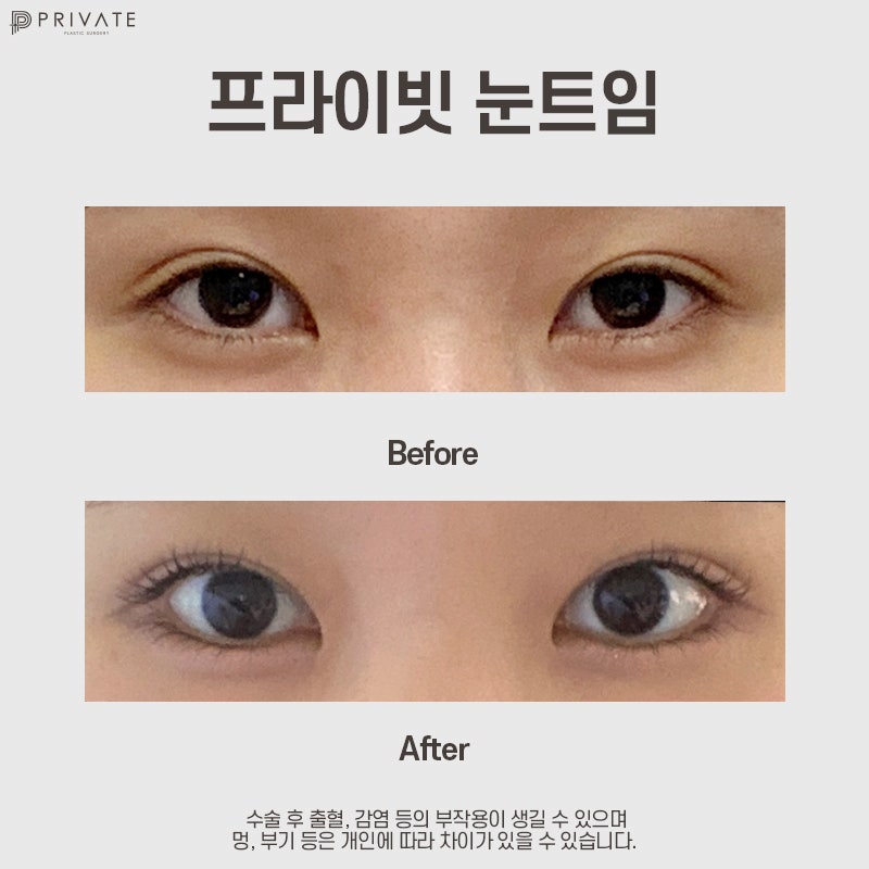 Ulasan Bagus Operasi Canthoplasty Lateral dan Epicanthoplasty Lateral di Private Plastic Surgery Sinsa-dong 사진 11