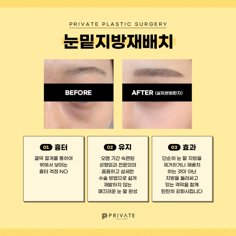 눈밑지 후기 좋은곳 신사 프라이빗성형외과 사진 5