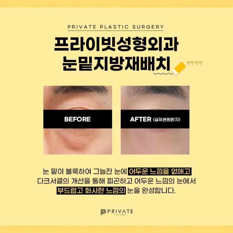 눈밑지 후기 좋은곳 신사 프라이빗성형외과