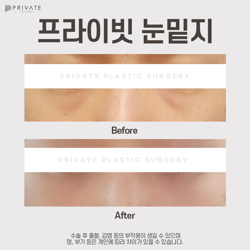 눈밑지 후기 좋은곳 신사 프라이빗성형외과 사진 8