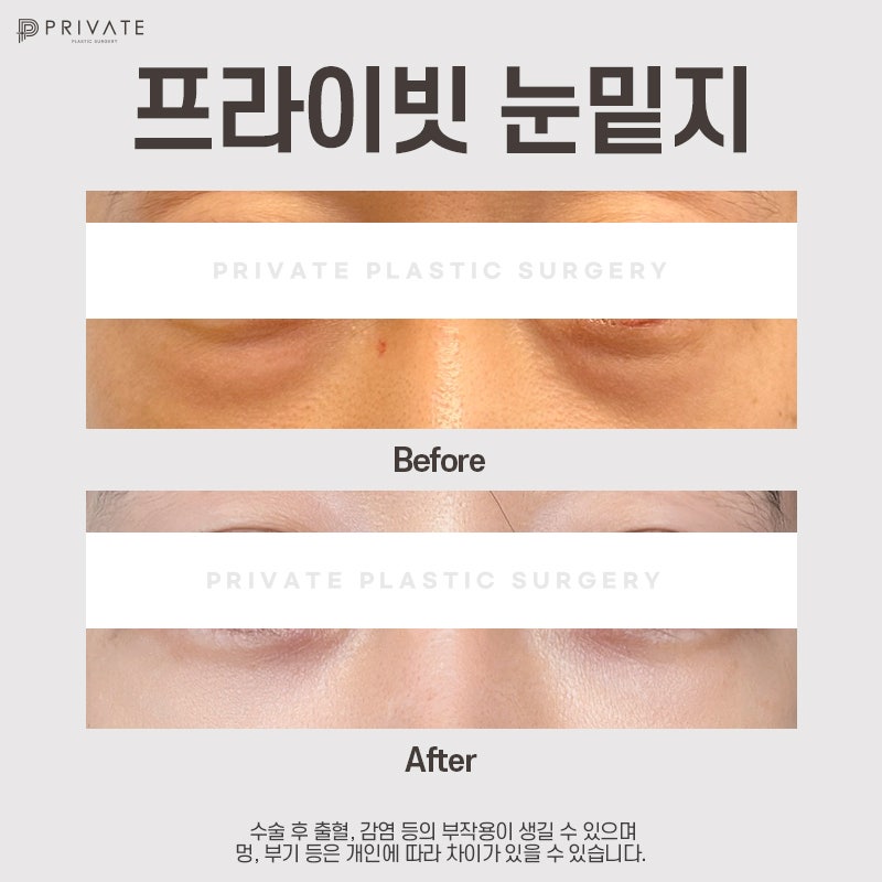 눈밑지 후기 좋은곳 신사 프라이빗성형외과 사진 7