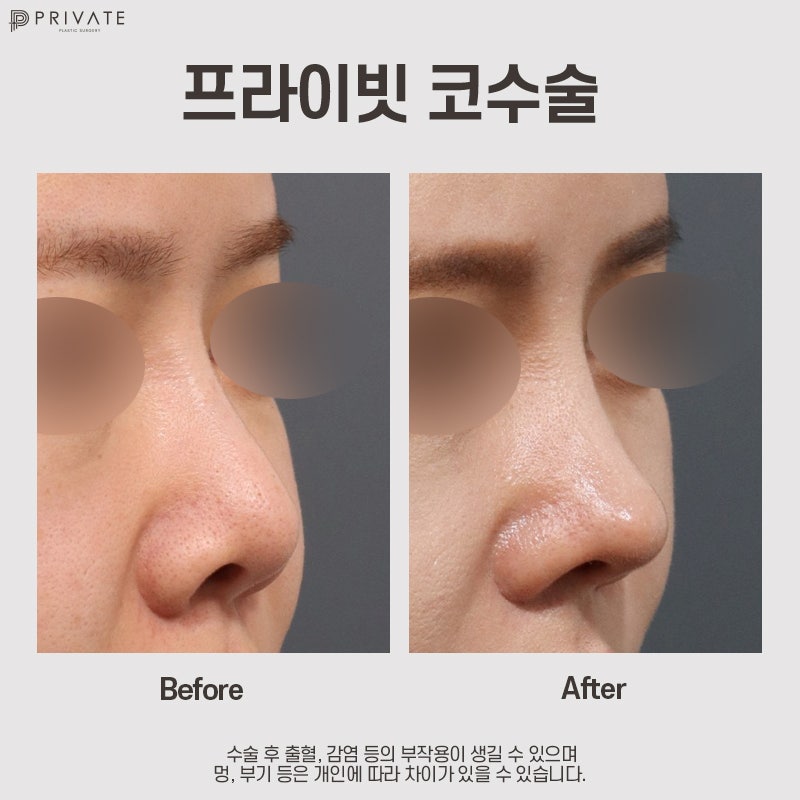 자가늑 코수술 후기 좋은 프라이빗성형외과 사진 9