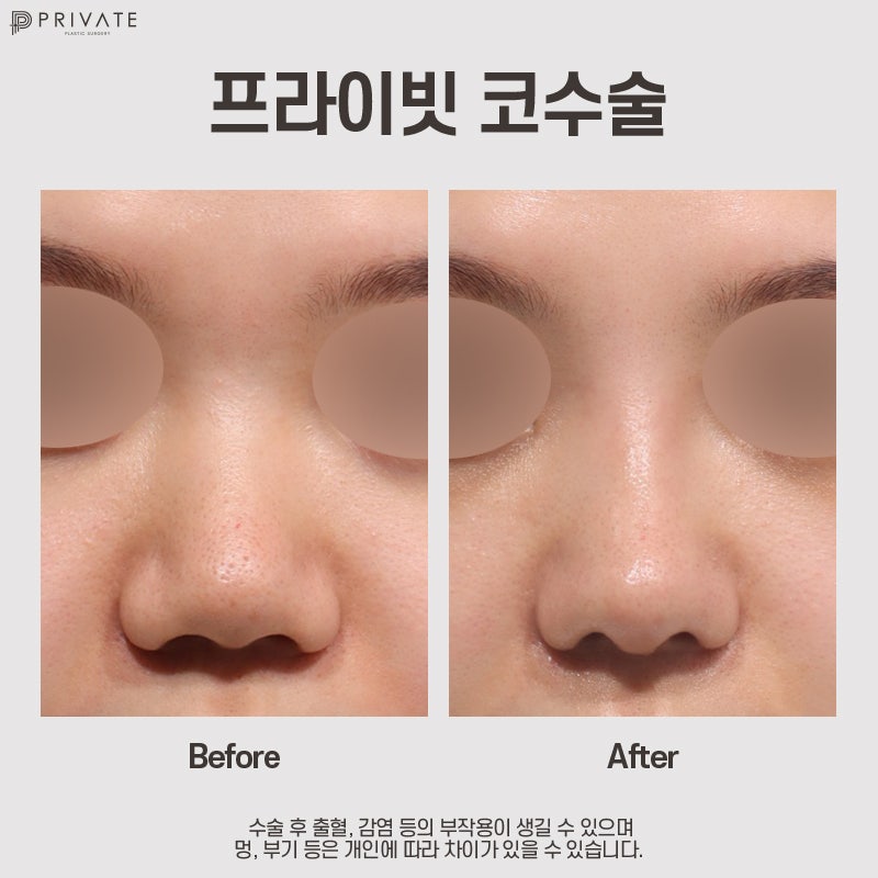 자가늑 코수술 후기 좋은 프라이빗성형외과 사진 7