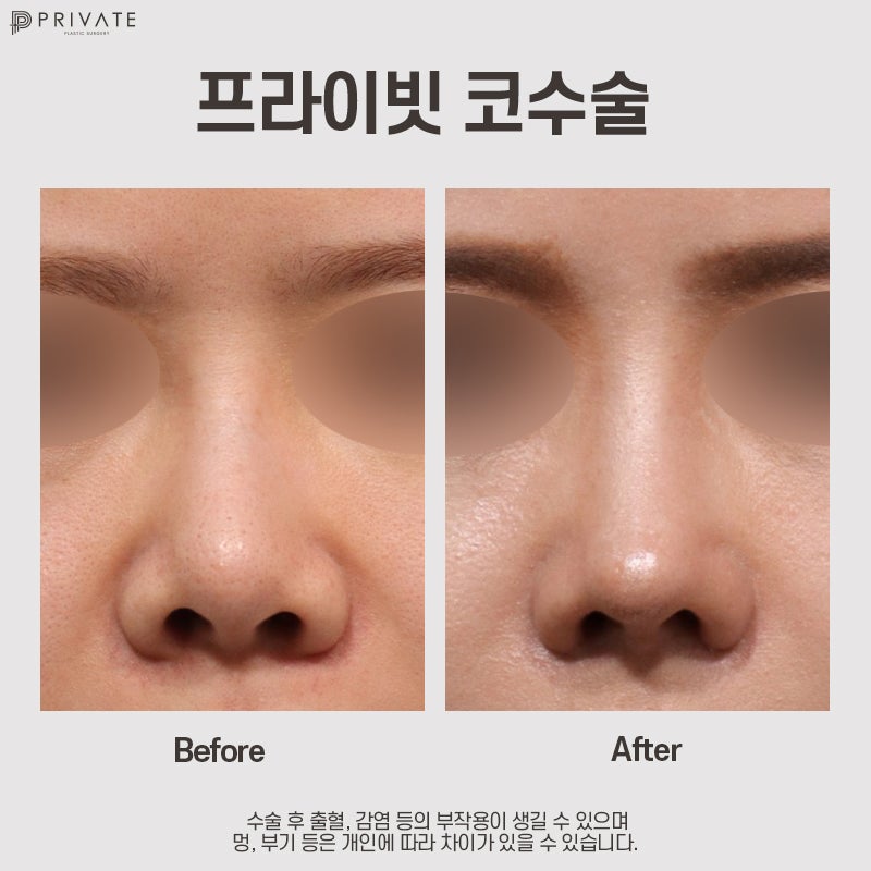자가늑 코수술 후기 좋은 프라이빗성형외과 사진 10