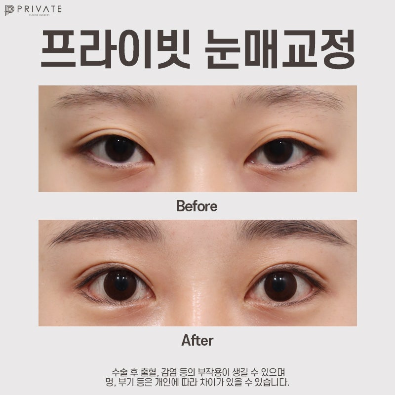 눈매교정술 프라이빗성형외과에서 알아보기 사진 7
