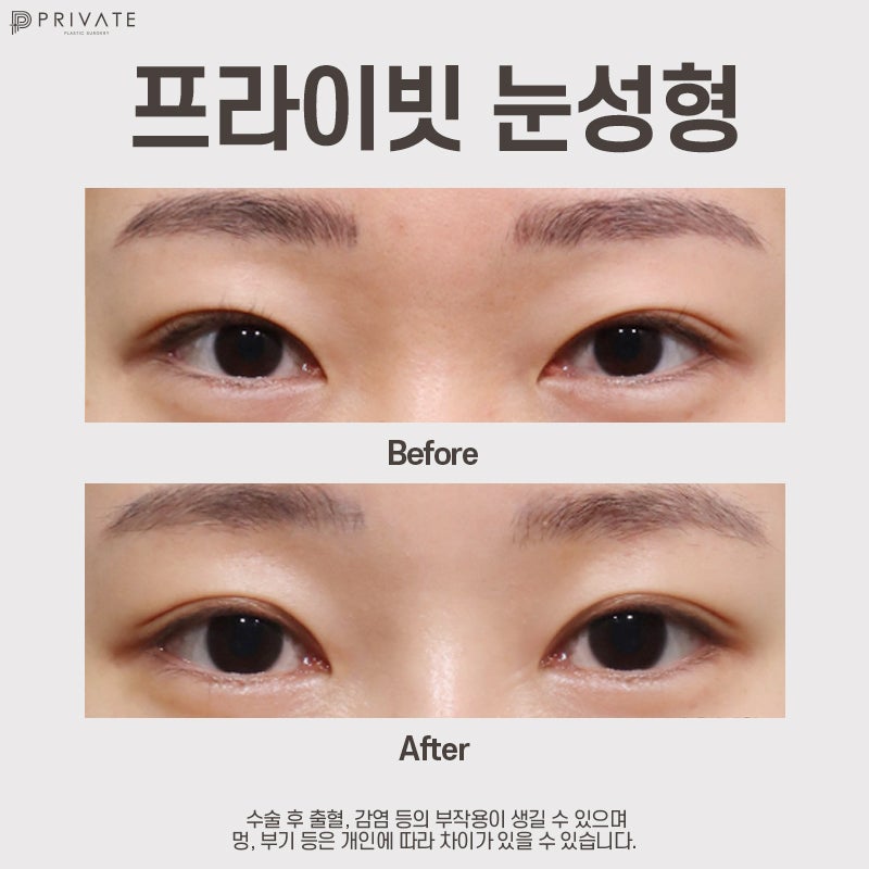 쌍수잘하는곳 신사 프라이빗성형외과 사진 9
