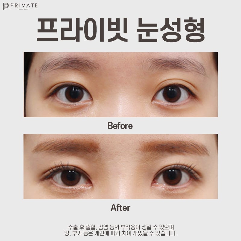 쌍수잘하는곳 신사 프라이빗성형외과 사진 8