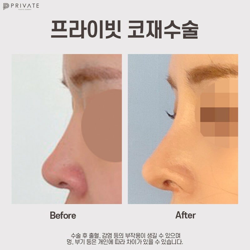 코재수술후기가 궁금하다면 신사 프라이빗성형외과 사진 8