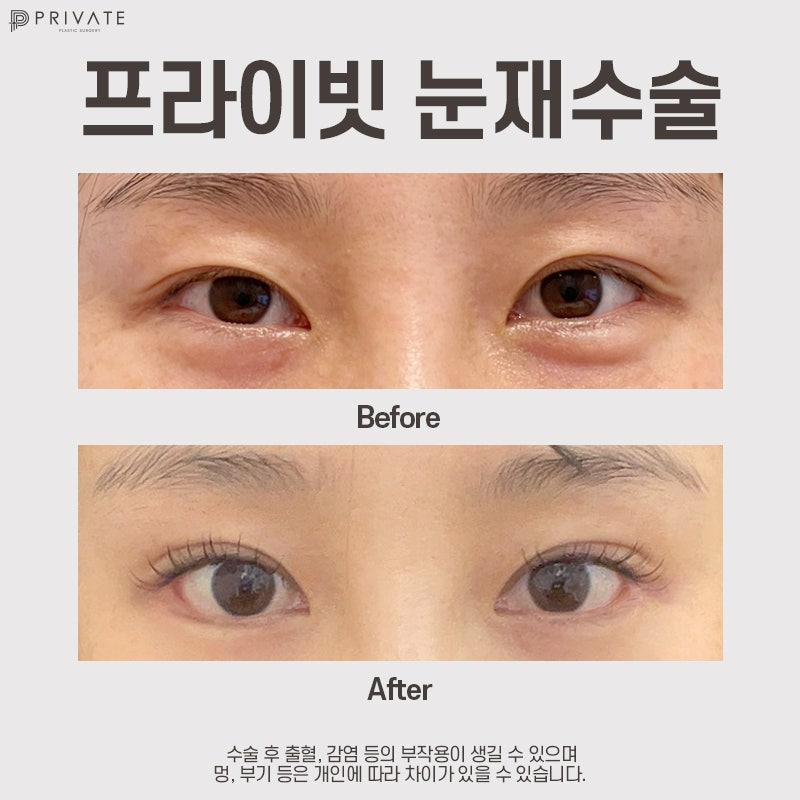 눈재수술후기 좋은 신사 프라이빗성형외과 사진 7