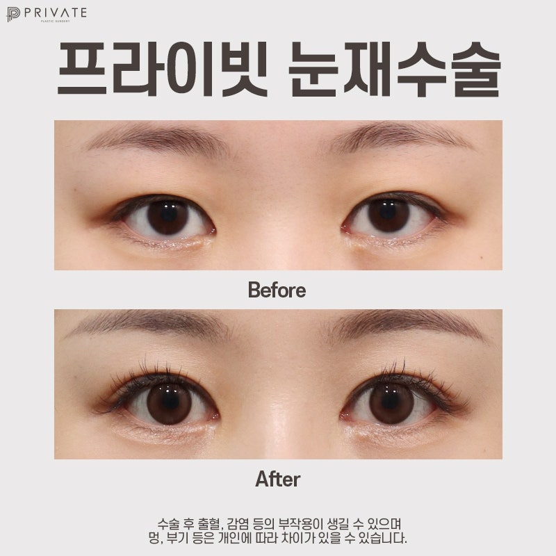 눈재수술후기 좋은 신사 프라이빗성형외과 사진 8