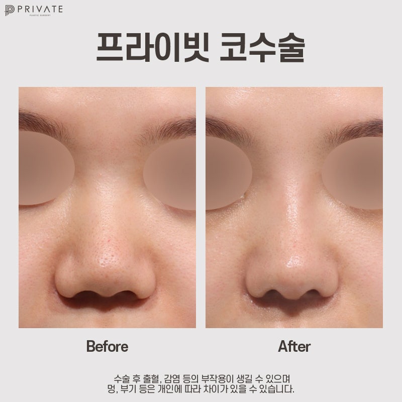 복코성형전후 볼 수 있는 신사 프라이빗성형외과 사진 8