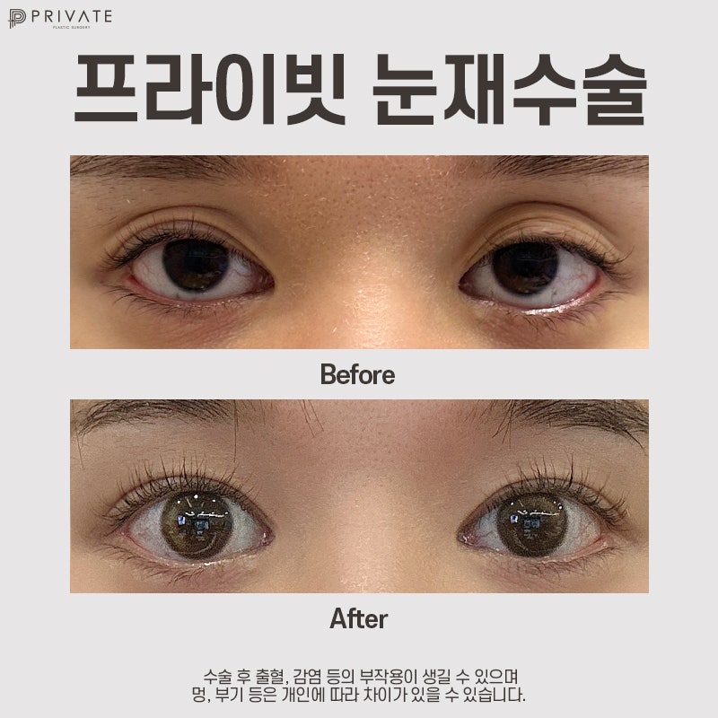 눈재수술잘하는곳은 신사 프라이빗성형외과 사진 8