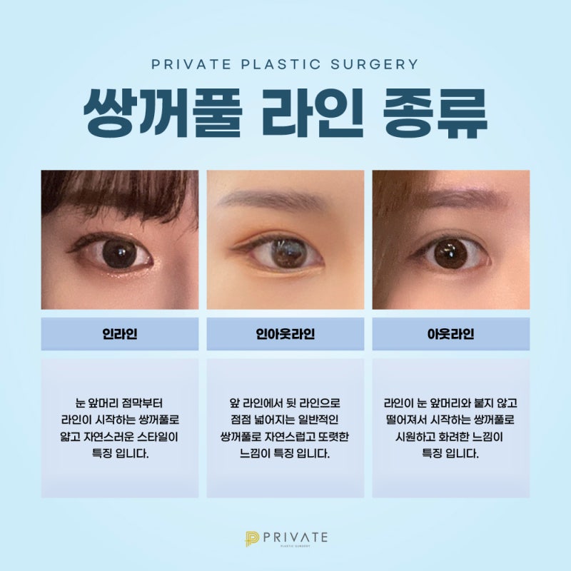 자연유착 재수술 후기 좋은 프라이빗성형외과 사진 5