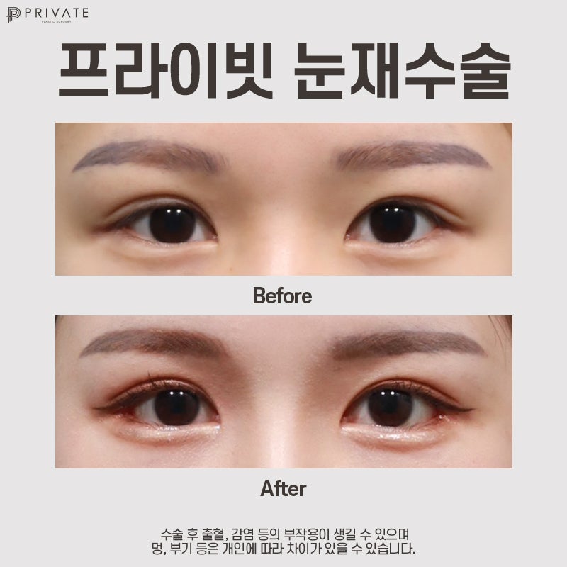 자연유착 재수술 후기 좋은 프라이빗성형외과 사진 9